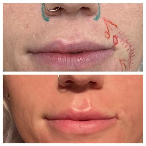 Lips before and after lip filler, with fuller shape and definition