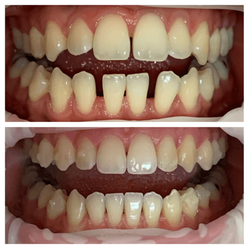 Invisalign before and after results