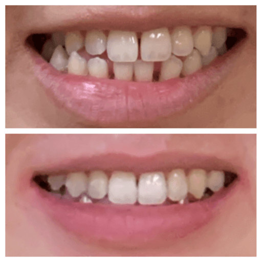 Invisalign before and after results