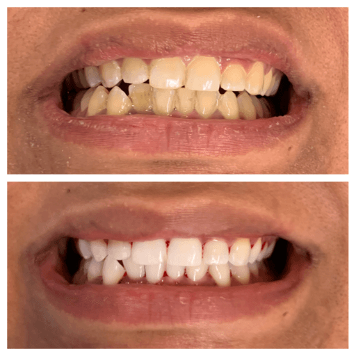 Smile before and after KöR teeth whitening, from yellow to bright white